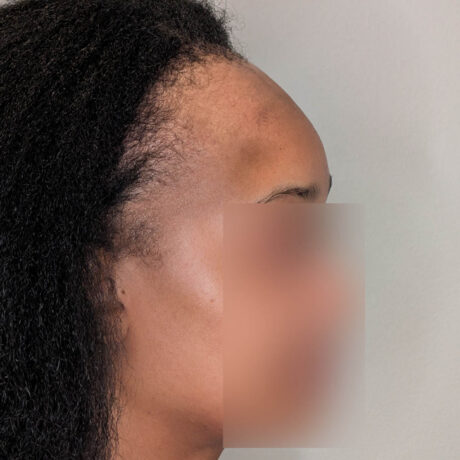 Forehead Reduction case #5913