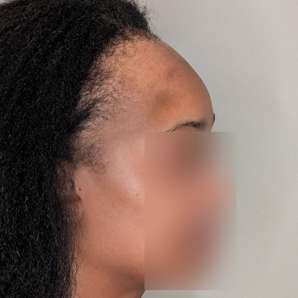 Forehead Reduction case #5913