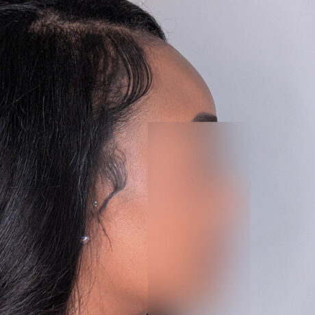 Forehead Reduction case #5913