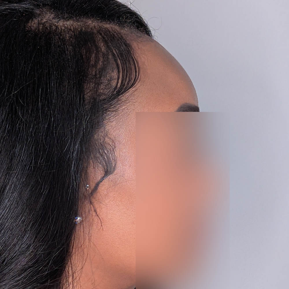 Forehead Reduction case #5913