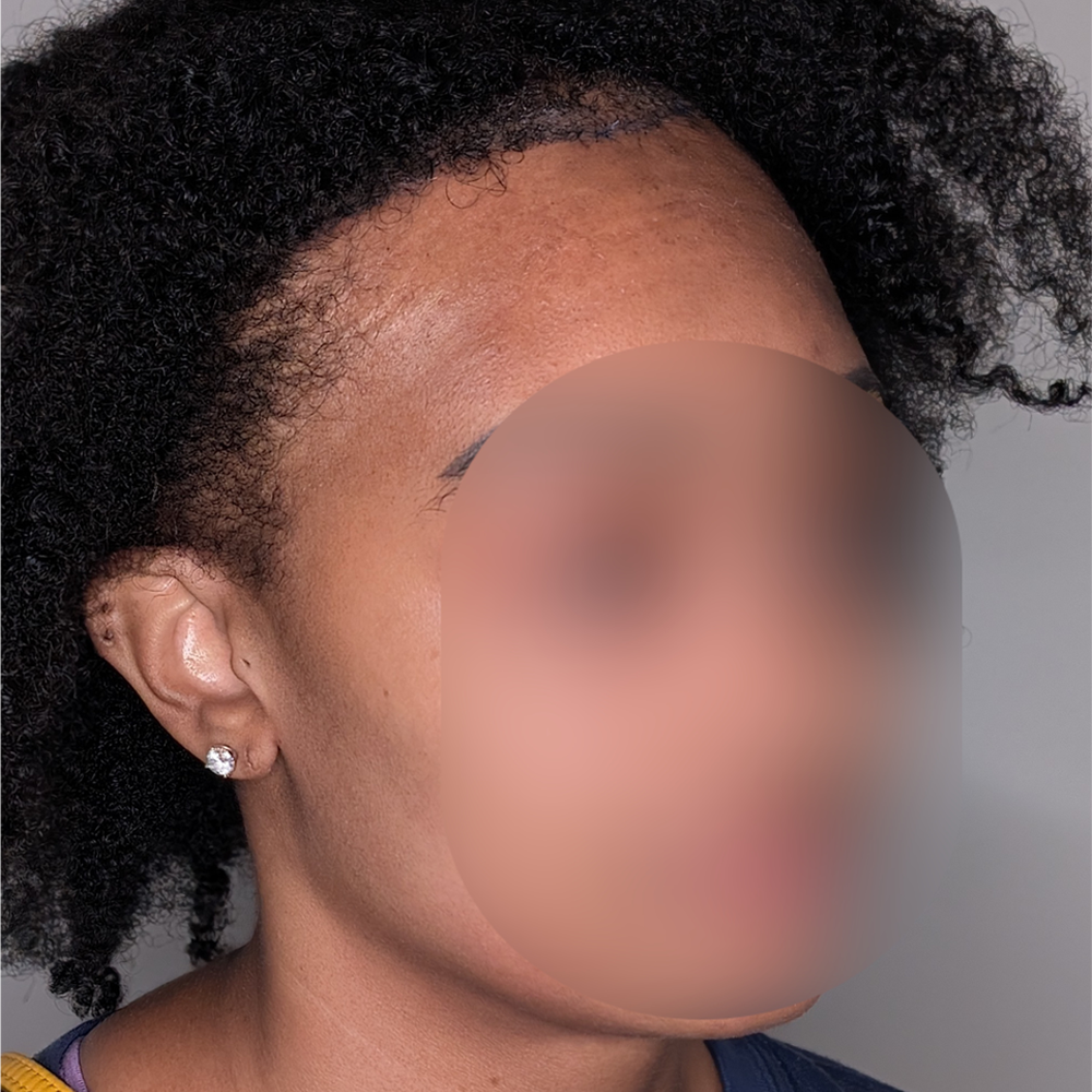 Forehead Reduction case #5913