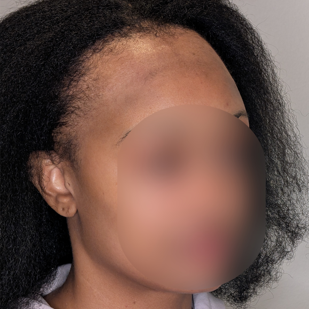 Forehead Reduction case #5913