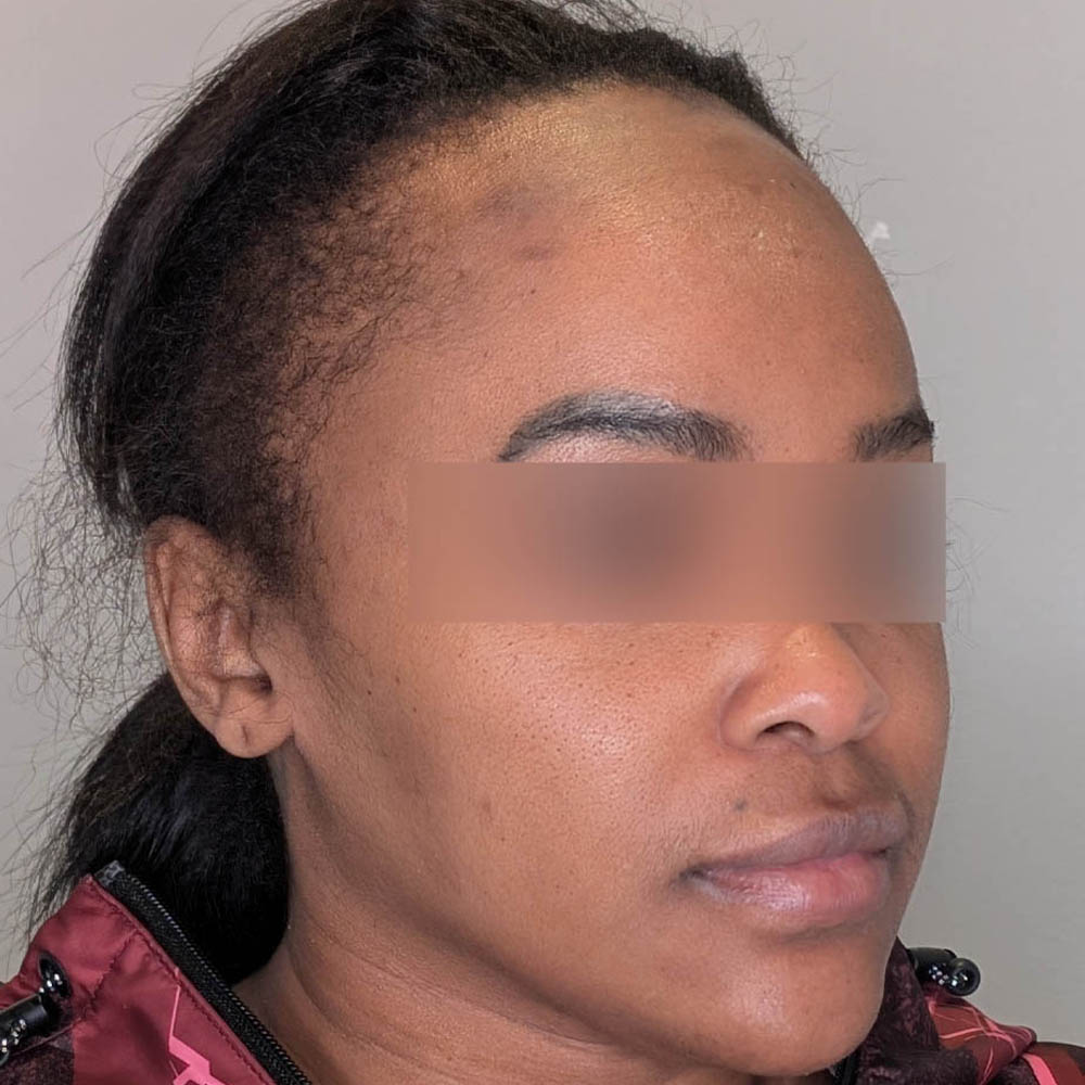 Hairline Lowering case #6045