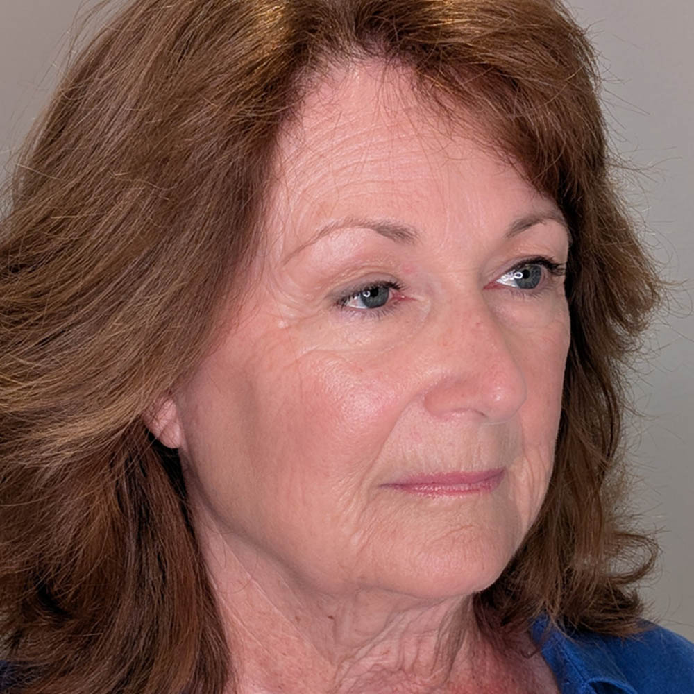 1_0000_Before Facelift.jpg