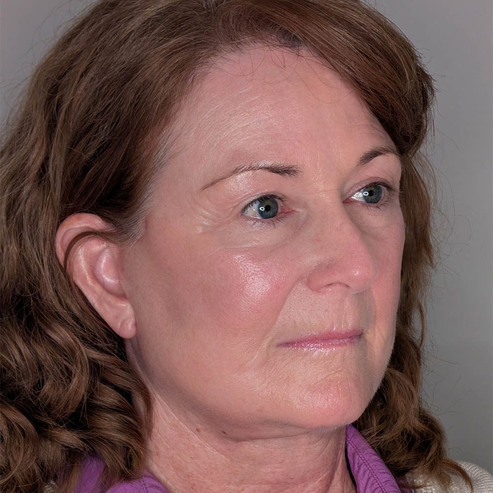 1_0001_After Facelift.jpg