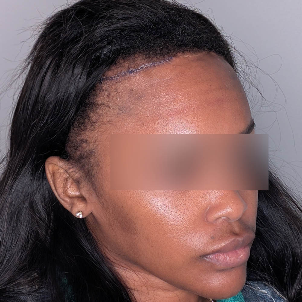 Hairline Lowering case #6045