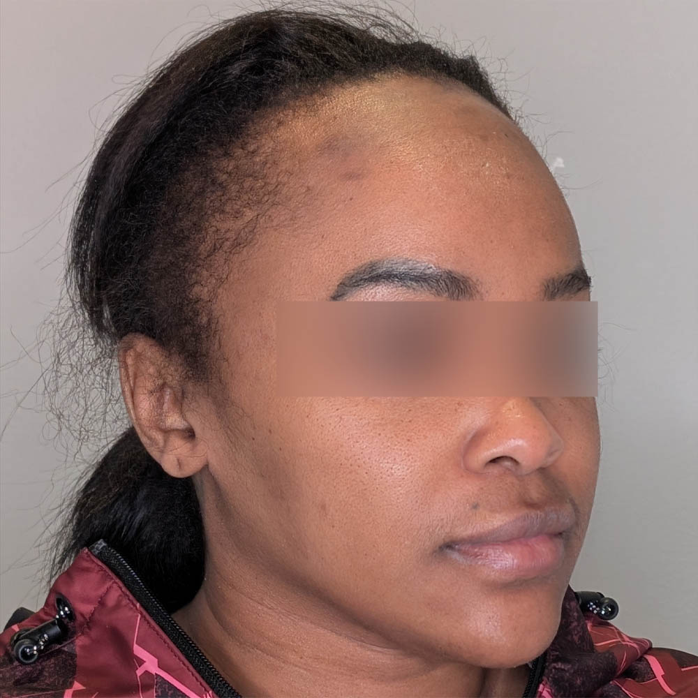 Hairline Lowering case #6045