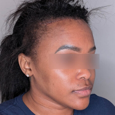 Hairline Lowering case #6045