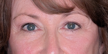 Lower Eyelid Surgery case #6057