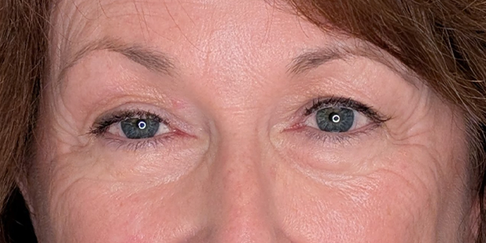 Lower Eyelid Surgery case #6057