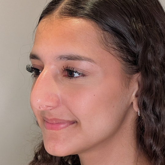 Rhinoplasty-Before-3