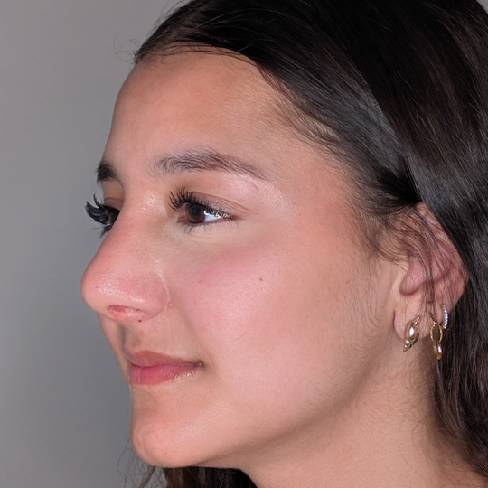 Rhinoplasty-after-3