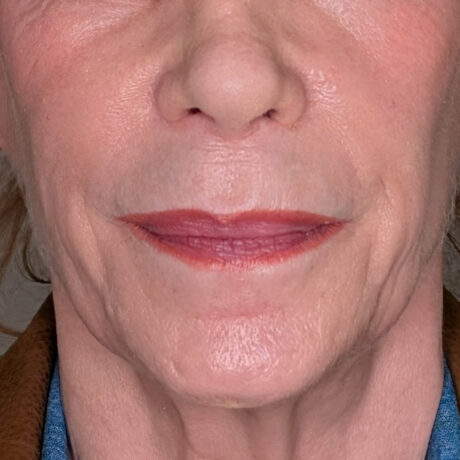 Lip Lift case #6267