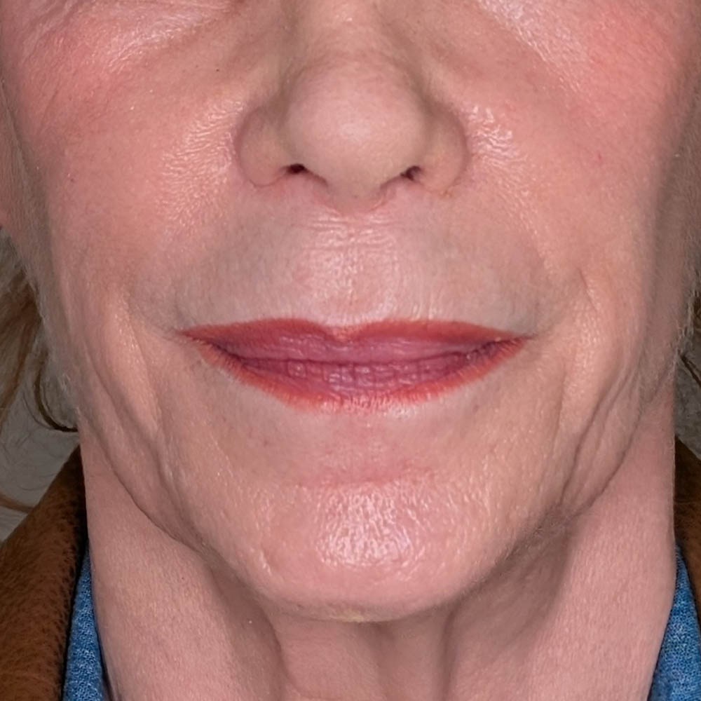 Facelift case #6166