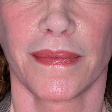 Lip Lift case #6267