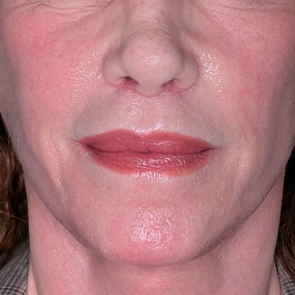 Facelift case #6166