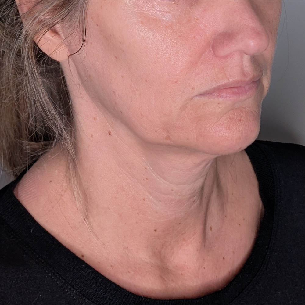 Facelift case #6173