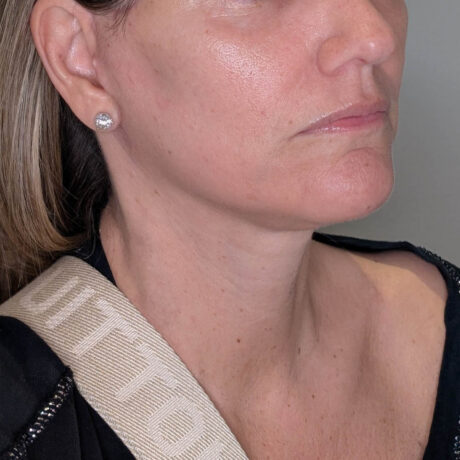 Facelift case #6173