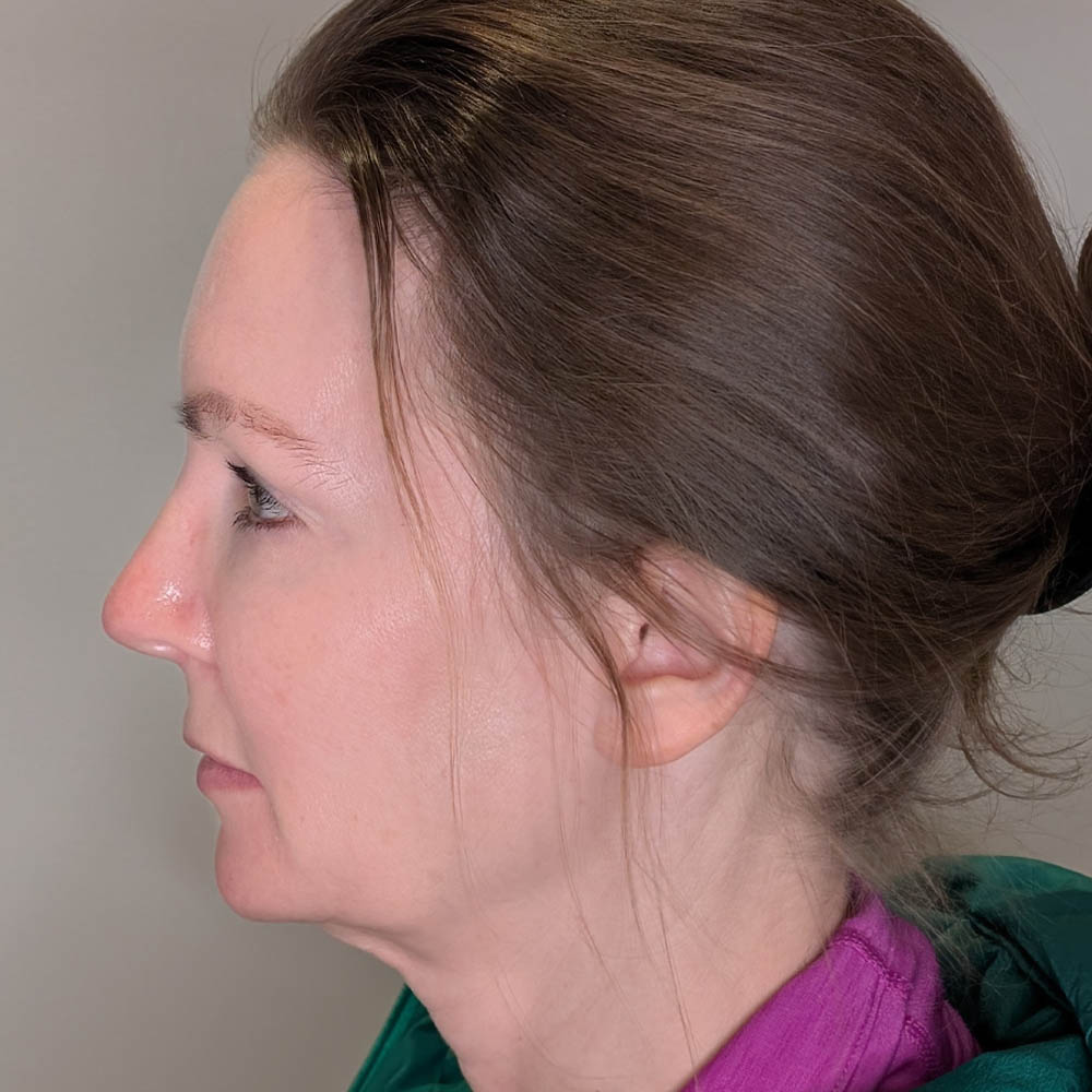 Facelift case #6179