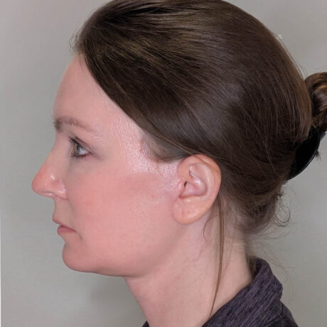 Facelift case #6179