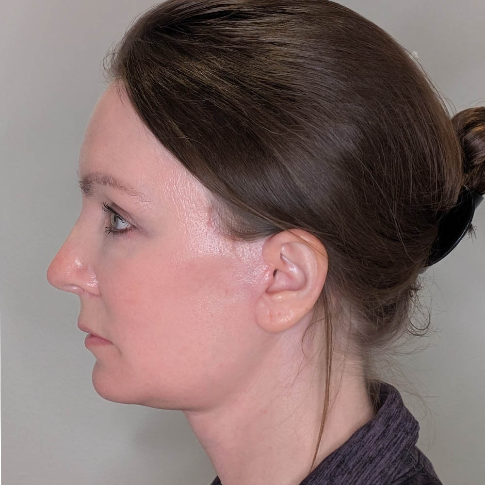 Facelift case #6179