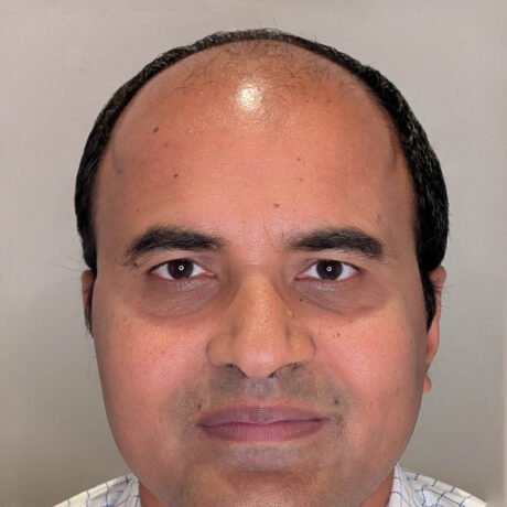 Hair Transplant case #6183