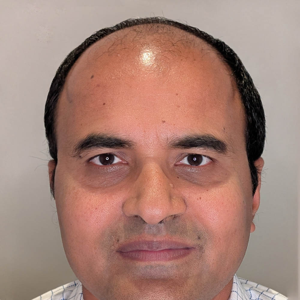 Hair Transplant case #6183