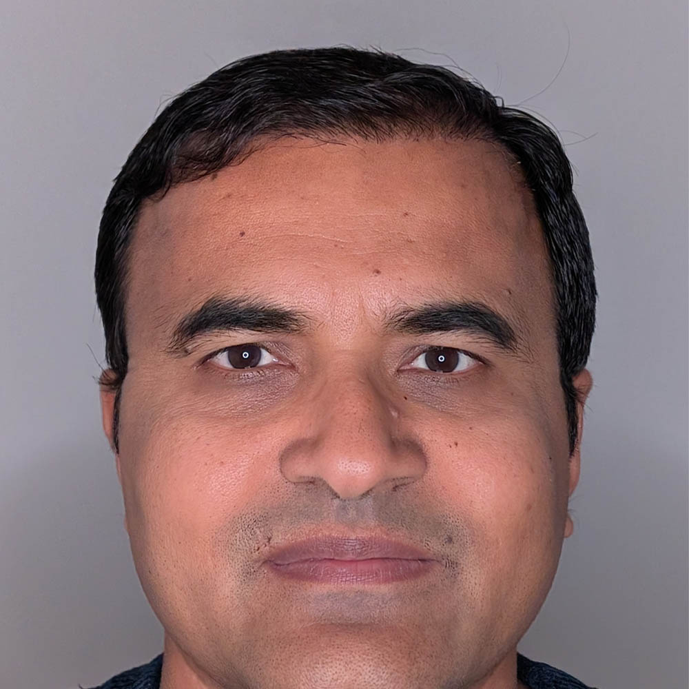 Hair Transplant case #6183