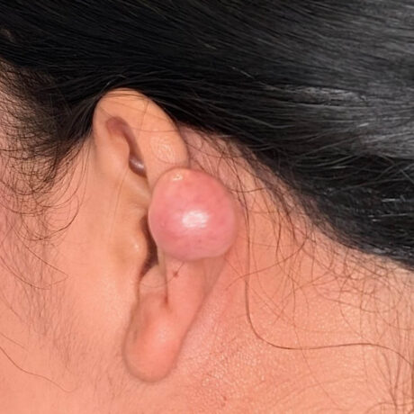 Keloid Removal case #6186