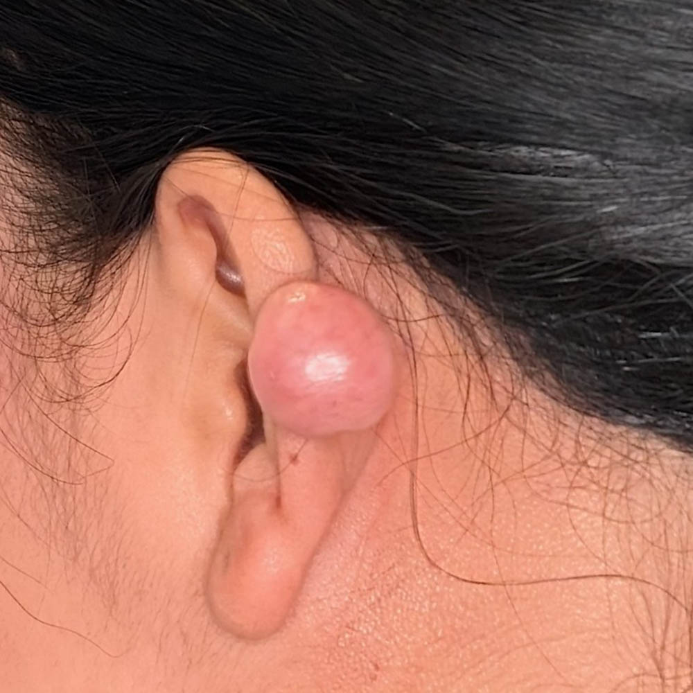 Keloid Removal case #6186