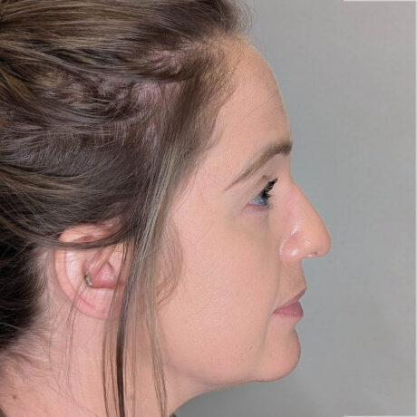 Rhinoplasty case #6189