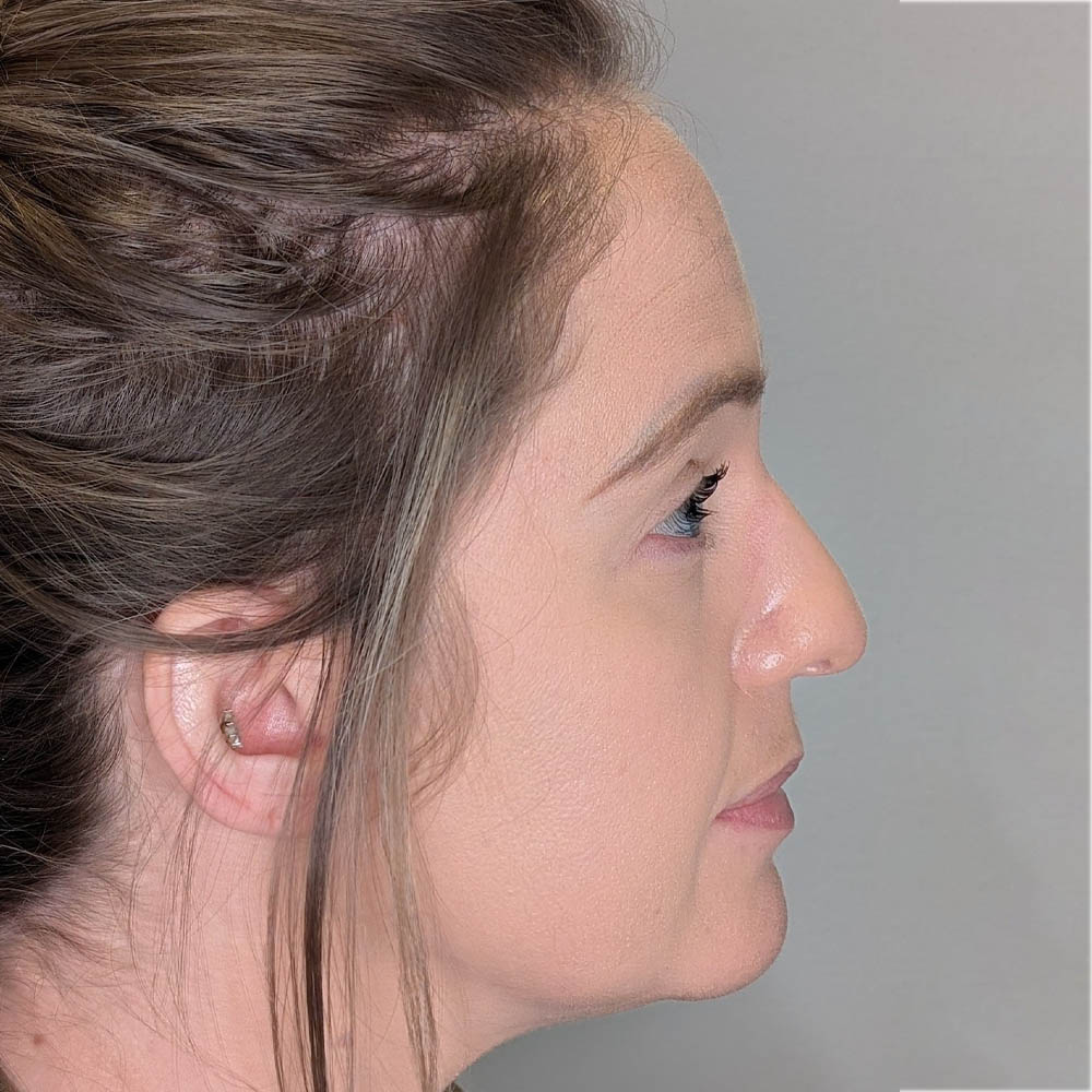 Rhinoplasty case #6189