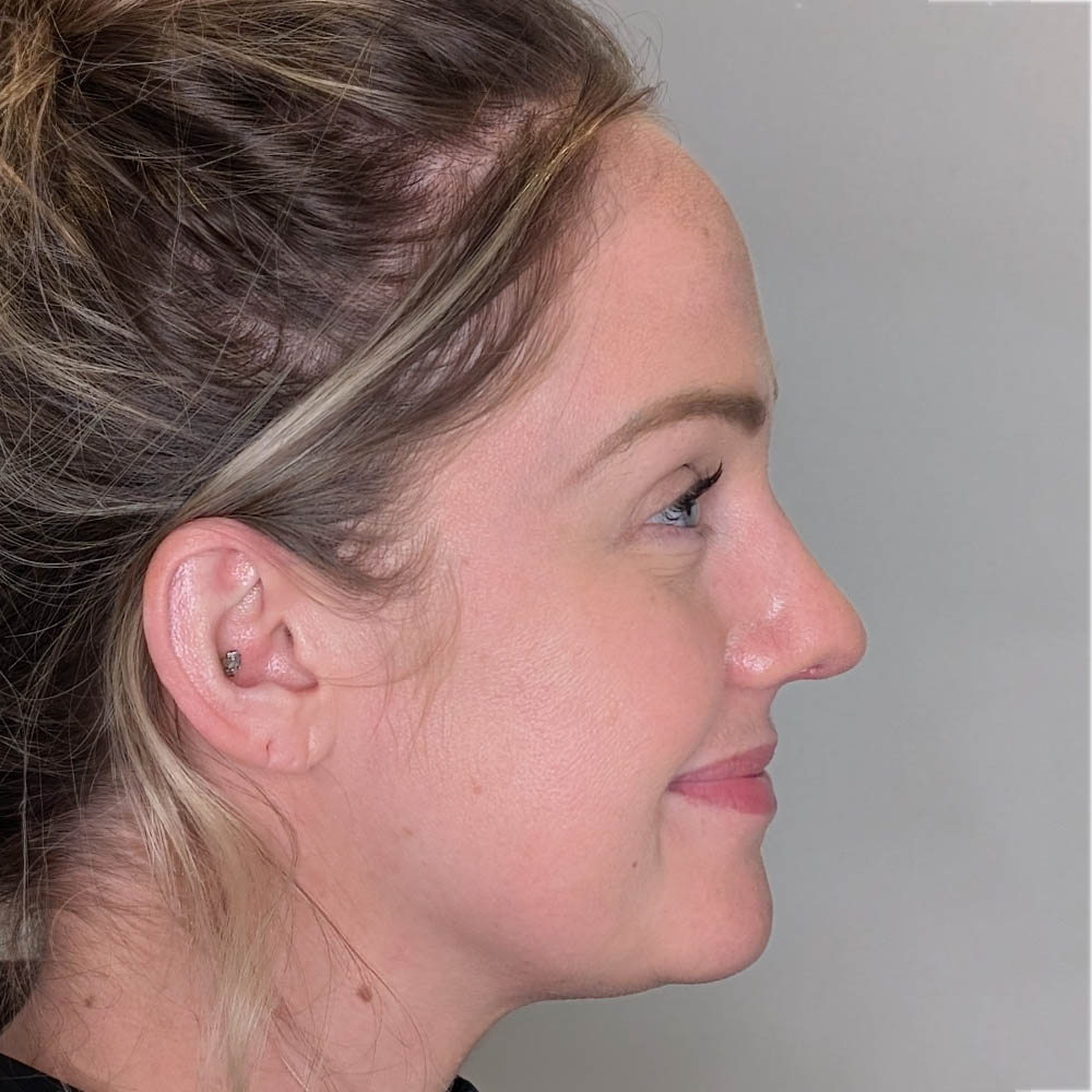 Rhinoplasty case #6189