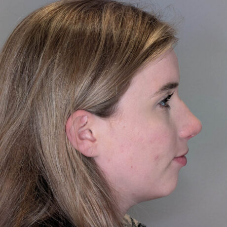 Rhinoplasty case #6192
