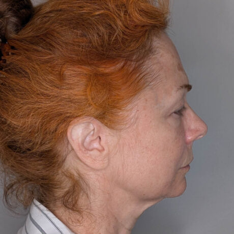 Facelift case #6412