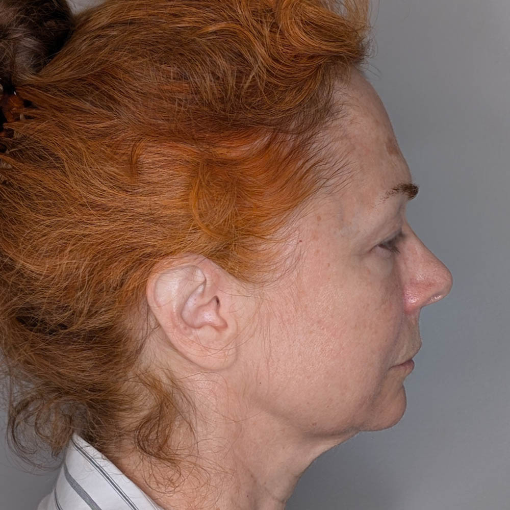 Facelift case #6412