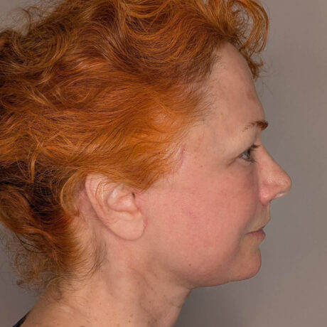 Facelift case #6412