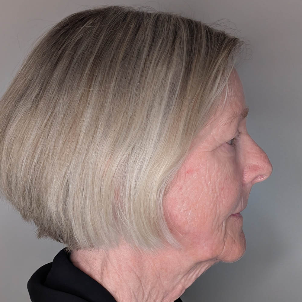 Facelift case #6418