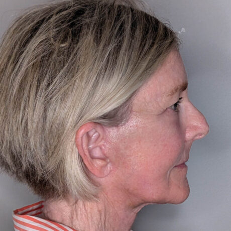 Facelift case #6418