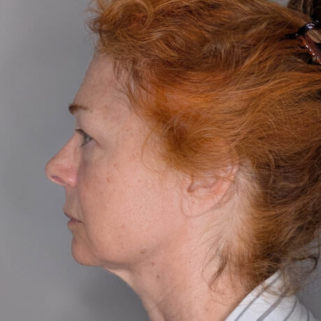 Facelift case #6412