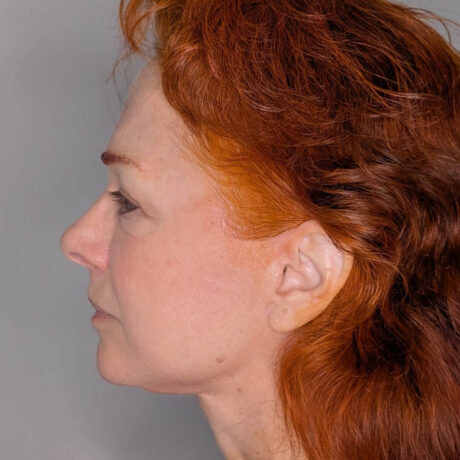 Facelift case #6412