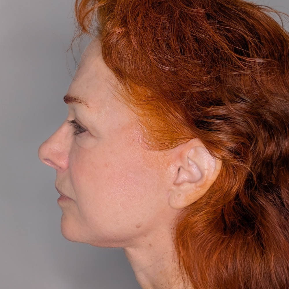 Facelift case #6412