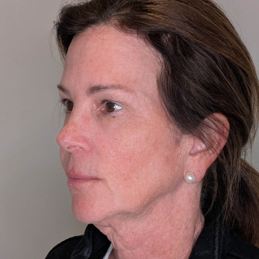 Facelift case #6431