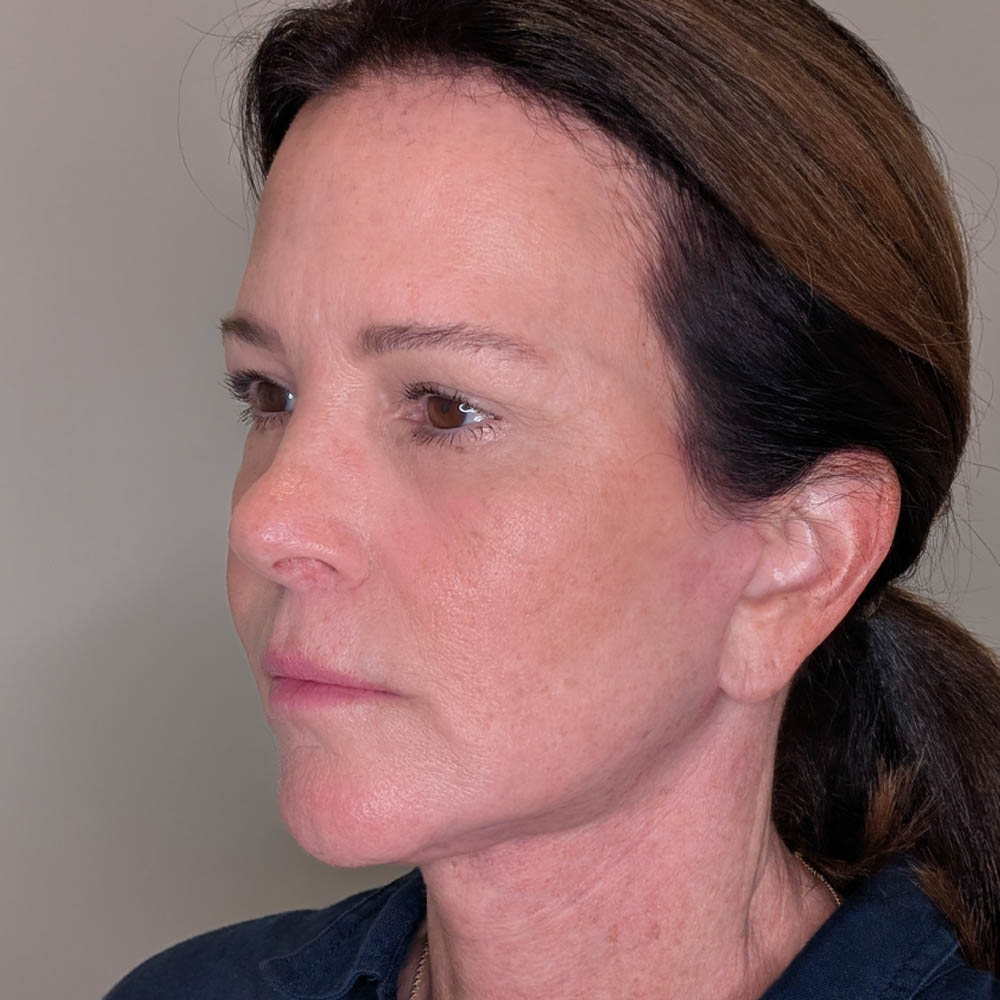 Facelift case #6431
