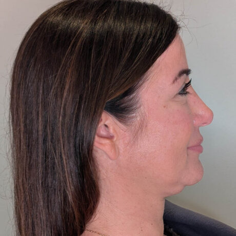 Ponytail Facelift case #6437