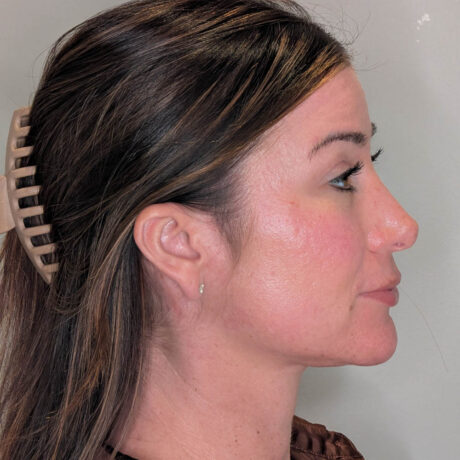 Ponytail Facelift case #6437