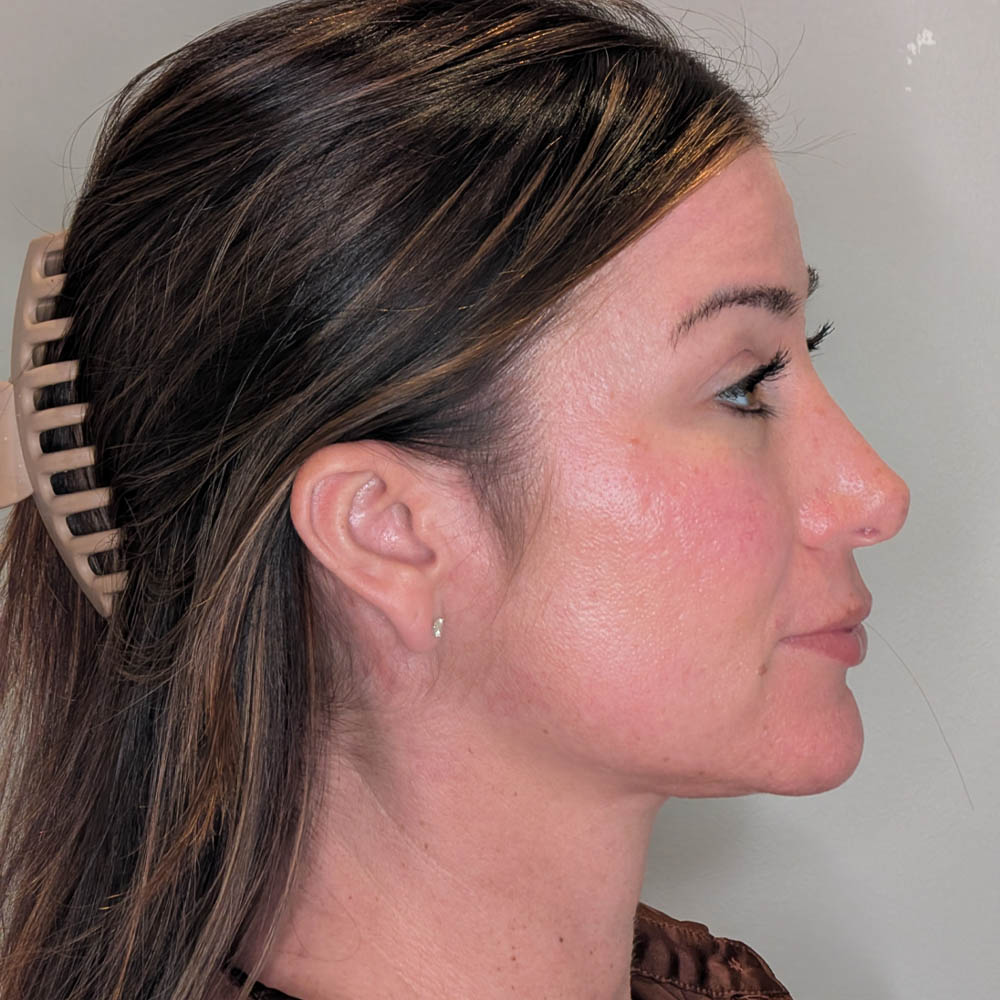 Ponytail Facelift case #6437