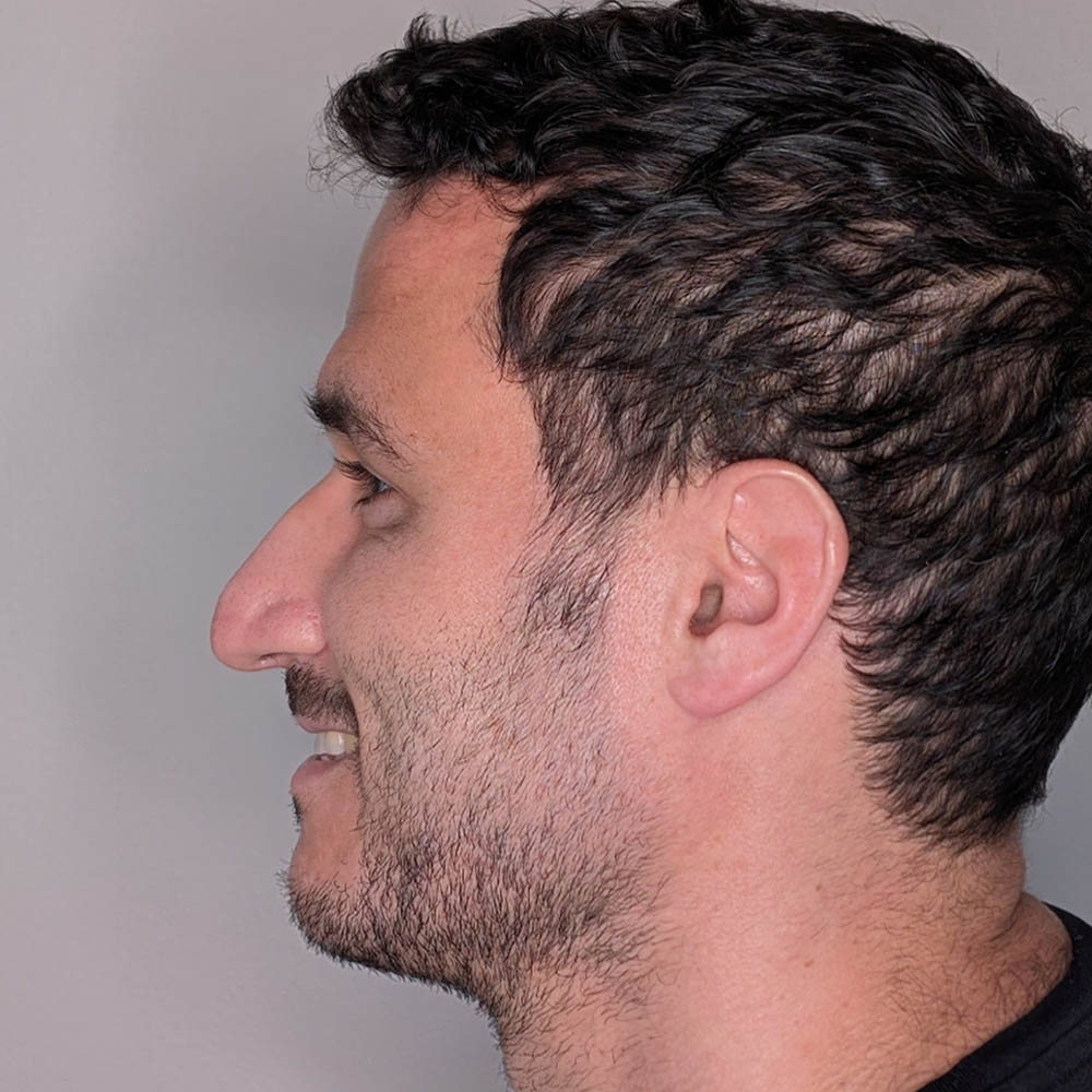 Rhinoplasty case #6443