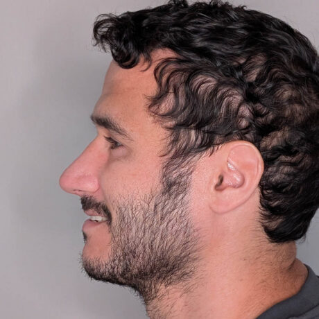 Rhinoplasty case #6443