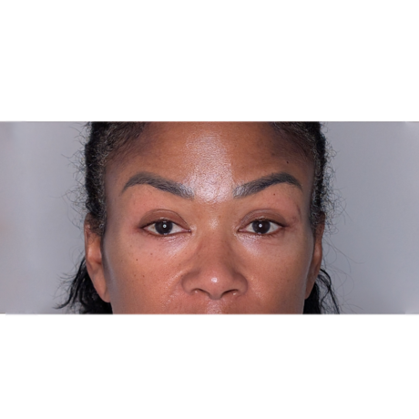 Brow Lift case #6399